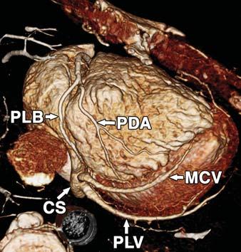 , xial 10-mm maximum-intensity-projection (MIP) image in 51-year-old man shows typical tortuous course of posterior descending artery as it arises from distal right