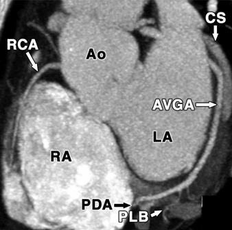 CT ngiography of Coronary rterial and Venous natomy C Fig. 8 Dominant left circumflex artery and posterior descending artery anatomy.