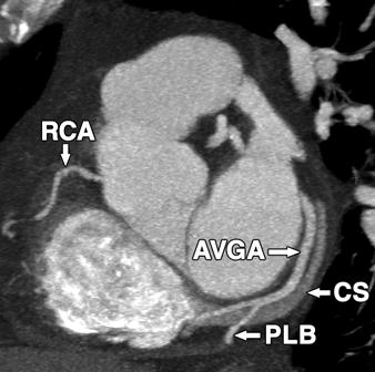 posterior lateral branch, R = right atrium, RC = right coronary artery.