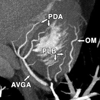 of right coronary artery: one in 43-year-old woman () and one in 44-year-old man ().