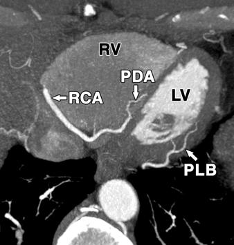 C, xial 10-mm MIP image shows dual posterior descending arteries as they arise from distal atrioventricular groove artery in 44-year-old man with dominant left