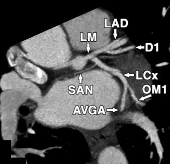 Fig. 11 Left main coronary artery bifurcation.