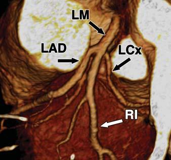 , Right anterior oblique caudal 10-mm maximum-intensity-projection (MIP) image displays trifurcation of left main coronary artery into left anterior descending