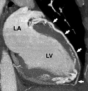 , xial 10-mm MIP image shows left main coronary artery dividing into left anterior descending artery, left circumflex artery, and ramus intermedius branches in
