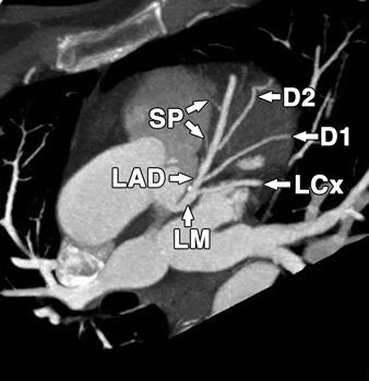 , Short-axis (left anterior oblique) 5-mm MIP image at level of myocardial bridge shows left anterior descending artery (arrow) deep to right ventricular myocardium junction