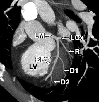 D1 = first diagonal, D2 = second diagonal, LD = left anterior descending artery, LCx = left circumflex artery, LM = left main coronary artery, LV = left ventricle, RI =