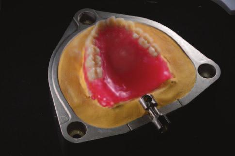 When it comes to the arena of acr ylic prosthetics, particularly implant supported restorations, it becomes even more critical that a dense, durable acrylic with an adequate impact strength is used.
