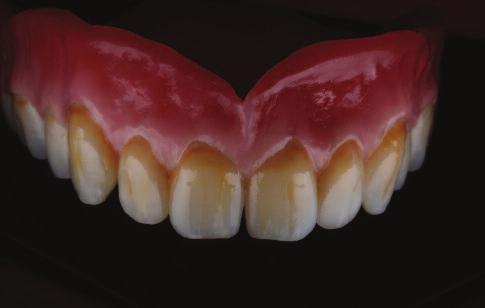 Bite forces with mandibular implant-retained overdentures. J Dent Res.