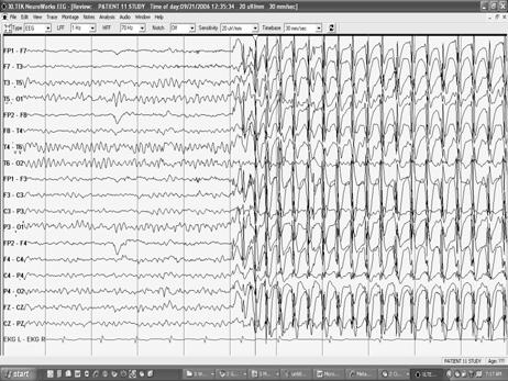 Childhood absence epilepsy EEG Course 2010: Generalized Epileptiforms Pongkiat Kankirawatana, MD.