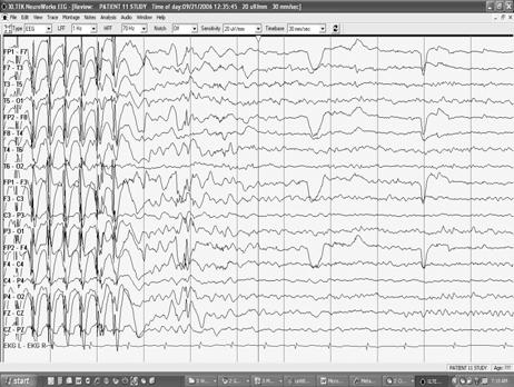 with abrupt onset and termination onset 3-10 yrs; peak 5-7 years, female> male neurologically normal subject 3Hz Spike and wave