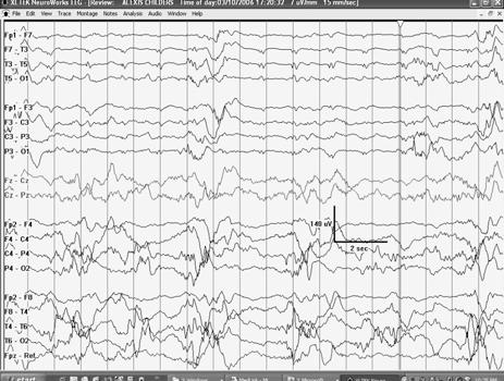EEG in SMEI Interictal EEGs: generalized and focal and multifocal anomalies Photosensitivity in 40% (Dravet et al 2002) Background is variable, often with an either transitory or permanent EEG: a