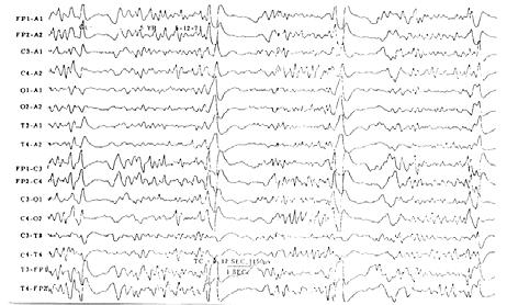 The Electroencephalogram in Subacute Sclerosing Panencephalitis Arch Neurol 1975 :32:719-26) 5 y/o with SSPE