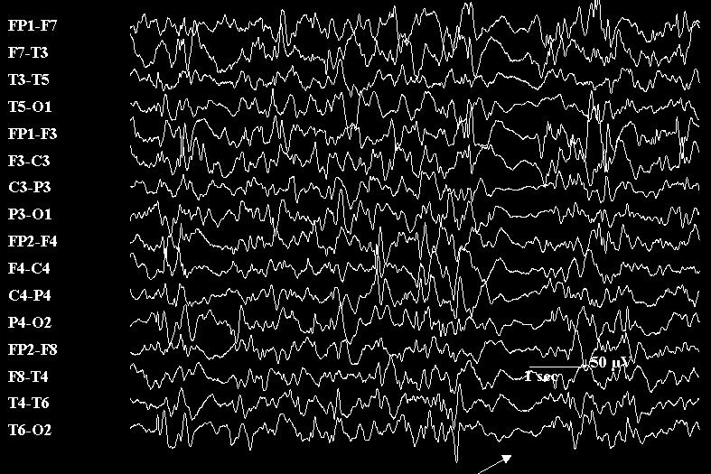 EEG patterns versus Stage of Sleep 100 90 80 70 60 50 40 30