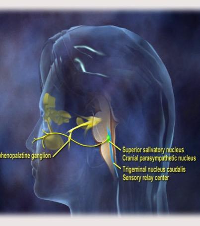 Why Is Migraine Frequently Mistaken for Sinus Headache?