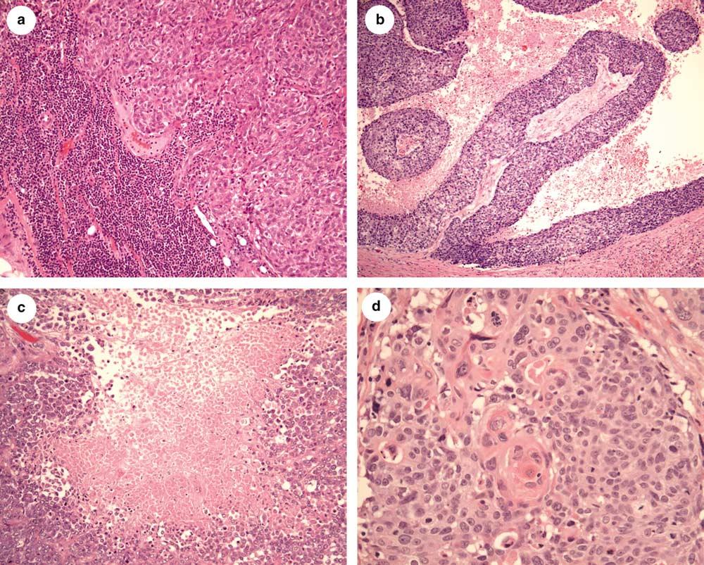 Phenotype of basal-like carcinoma 267 Figure 1 Morphologic features of basal-like carcinomas.