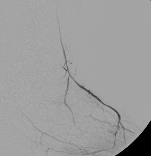 guidance Angiography from above the lesion to road map access vessels - Ultrasound guided access Identify