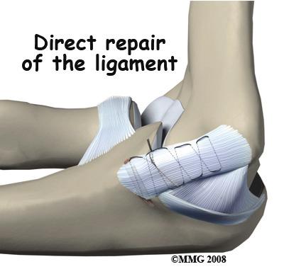 enough to sublux (partially dislocate), valgus stress radiographs may be taken. Magnetic resonance imaging (MRI) with contrast dye is used to diagnose ligamentous rupture.