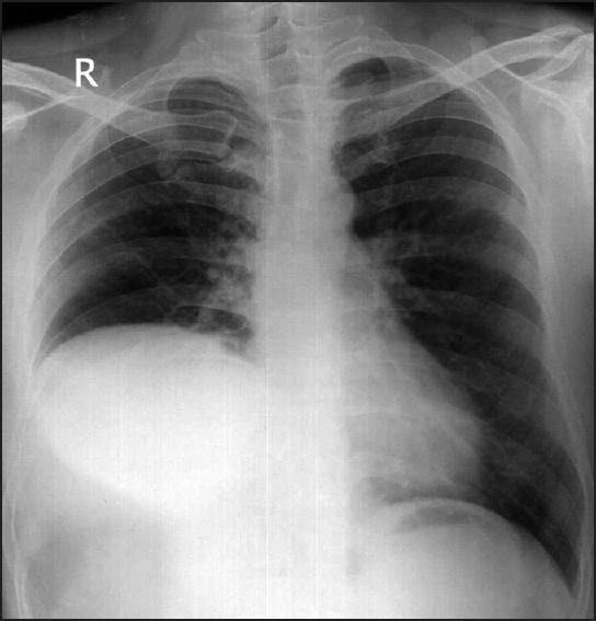 Extrinsic Causes Diaphragmatic weakness Estimated prevalence 10%