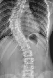 thoracotomies Scoliosis 16% of pts mod-severe scoliosis 5 fold
