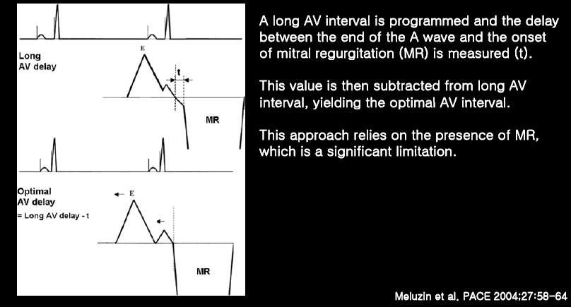AV Interval Optimization