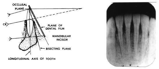 Correct horizontal angulation for successful radiographs exists when the central ray is perpendicular to the facial surfaces of the teeth and parallel to the mesial and distal surfaces (see figure