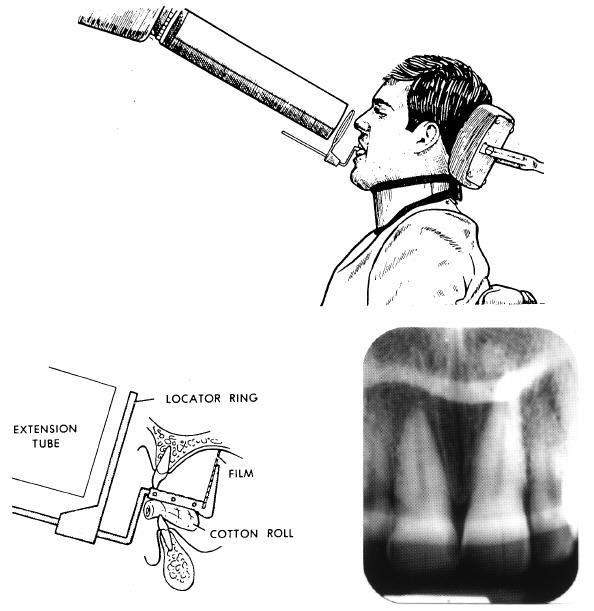 Figure 4-24. Maxillary incisor area. 4-24. MANDIBULAR MOLARS Position the posterior instrument assembly with the plastic bite-block centered on the second molar (see figure 4-25).