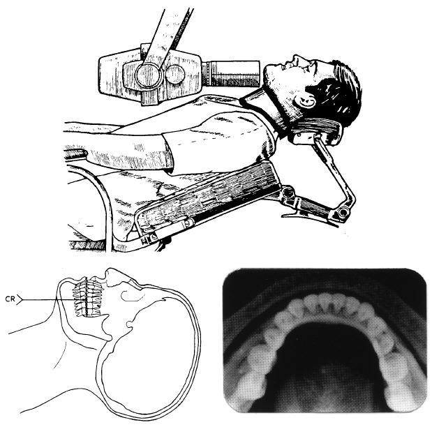 Tilt the head back so that the occlusal plane of the mandibular teeth is at right angles to the horizontal plane with the median plane (sagittal plane) of the face in a vertical position.