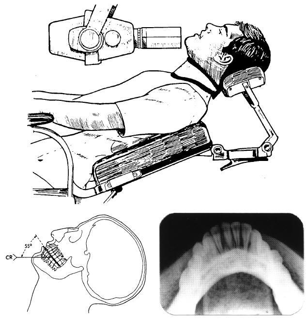 4-37. MANDIBULAR POSTERIOR OCCLUSAL Figure 4-34. Mandibular anterior occlusal view technique.