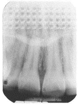Figure 3-18. Bleached image. 3-18. LEAD-FOIL IMAGE A lead-foil image (see figure 3-19) occurs when the embossing pattern from the lead foil backing appears on the radiograph.