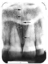 Figure 3-23. Median palatal suture. Figure 3-24. Nasal fossae. 3-26. RADIOPAQUE LANDMARKS ON MAXILLARY RADIOGRAPHS a.
