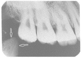 The coronoid process of the mandible (see figure 3-26) sometimes appears on maxillary molar films as a triangular opaque