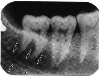 Figure 3-27. Zygomatic process (malar bone). d. Nasal Septum. The nasal septum is usually seen as a white ridge extending above and between the central incisors. 3-27. RADIOLUCENT LANDMARKS ON MANDIBULAR RADIOGRAPHS a.