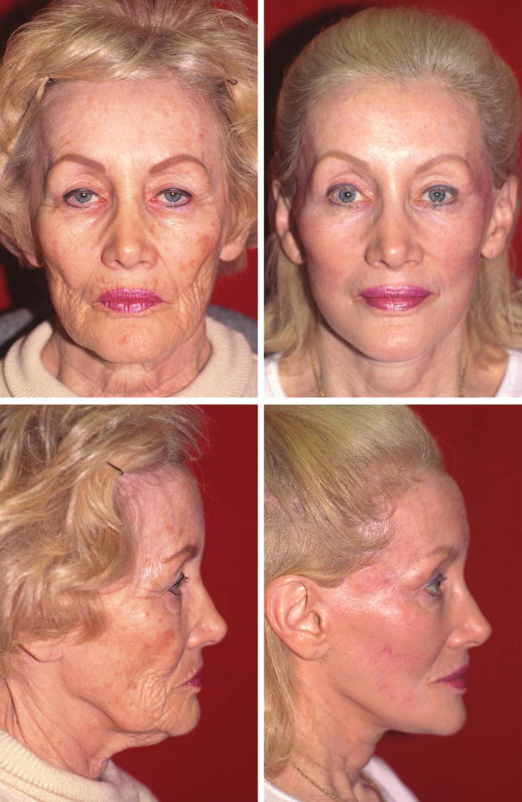 Volume 130, Number 5S-3 Vest-over-Pants Platysmarrhaphy Fig. 5. Patient before (left) and 1 year after (right) a rhytidectomy, platysmarrhaphy, ptosis correction, and full face laser resurfacing (frontal and profile views).