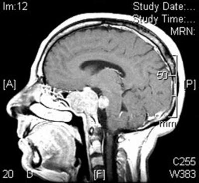Figure 3 Figure 1c: T1WI Sagittal MRI after intravenous contrast showing; enhancement of the tumour and its intradural component in front of the brain stem. with a median follow-up time of 3.