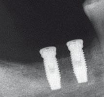 364 Felice et al Fig 1 Sequence of periapical radiographs showing one of the patients treated with interpositional block xenograft and longer implants, which were positioned slightly supracrestally: