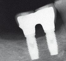 The peri-implant marginal bone levels remained substantially unaltered in this patient.