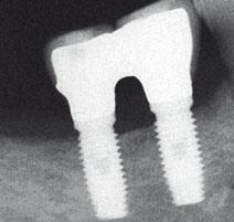 instead of receiving a prosthesis splinting the two implants together.