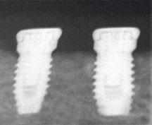Felice et al 365 a b c Fig 2 Sequence of periapical radiographs showing one of the patients treated with 6.
