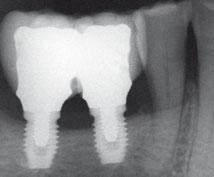 years after loading follow-up; (e) 5 years after loading follow-up. Some peri-implant marginal bone loss occurred in this patient over the 5-year period, especially at the distal implant.