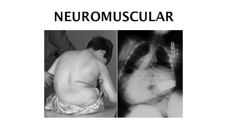 Curve due to abnormal/absent neuromuscular function