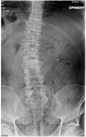 the spine with aging Left lumbar most common Factors for