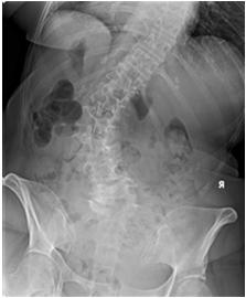 Laterolisthesis Lateral displacement of superior vertebra of a motion segment to the inferior one In the long run self