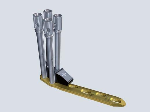 0 mm, length 2 mm, Titanium Alloy (TAN) To allow uniform orientation the four combination holes in the proximal shaft are numbered