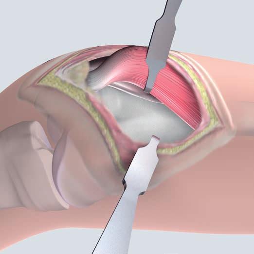 3 Approach With the knee joint in extended, position, an anteromedial longitudinal incision is made, starting 10 cm above the patella and ending in the upper third of the patella.