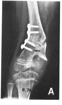 Growth disturbances after infantile osteornyelitis 9 Figure 11. Case 7. AP radiographs. A) Age 6 yrs 10 mo. State 7 weeks after second osteotomy, B) Age 10 yrs 1 mo. C) Age 15 yrs 4 mo.