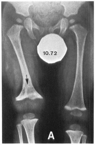 12 A. Langenskiold Figure 14. AP radiographs of special case. Osteomyelitis of both right femoral condyles in infancy. A) Age 1 yr 6 mo.