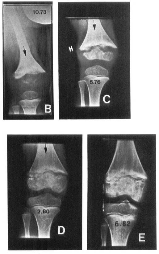 osteomyelitis to a normal shape after the bony nucleus had been complebely absent at the age of 1 year. On the other hand, metaphyseal growth was much impaired and at the age of 11 years there was 5.