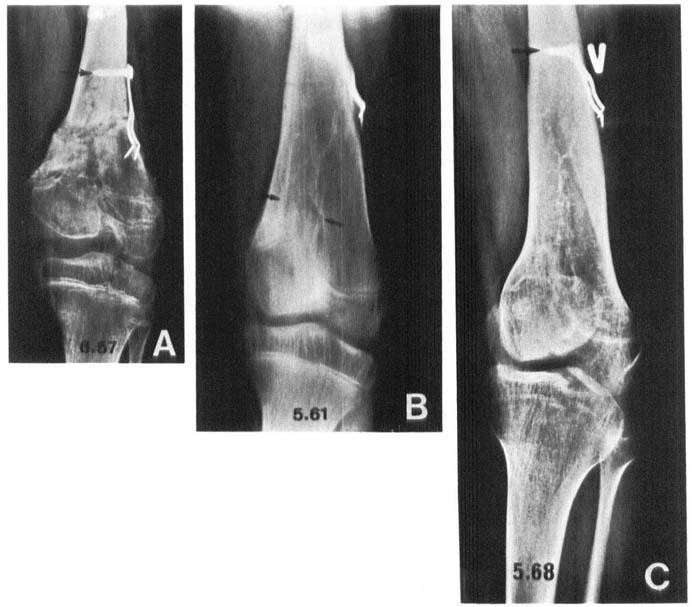 second osteotomy. Note radiolucent area in metaphysis (arrows). Figure 2. Case 1. AP radiographs.