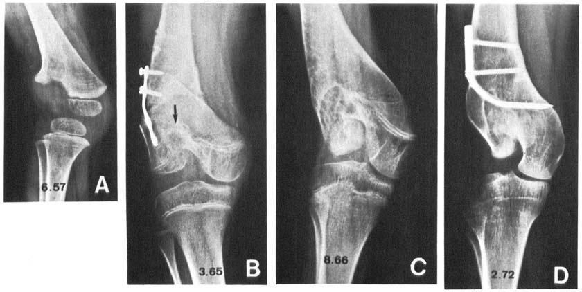 Growth disturbances after infantile osteomyelitis 5 Figure 3. Case 3. AP radiographs. A) Age 2 yrs 2 mo. State 1 yr 4 mo before first osteotomy, B) Age 10 yrs. State 6 weeks after third osteotomy.