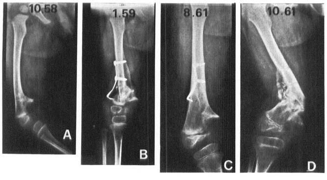6 A. Langenskiold Figure 5. Case 5. AP radiographs. A) Age 1 yr 2 mo.